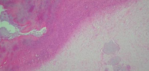 Coxim plantar direito de pinguim-de-Magalhães (Spheniscus magellanicus) com pododermatite grau III