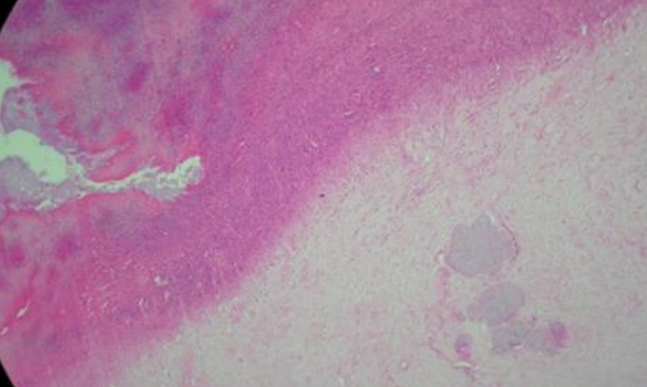 Coxim plantar direito de pinguim-de-Magalhães (Spheniscus magellanicus) com pododermatite grau III