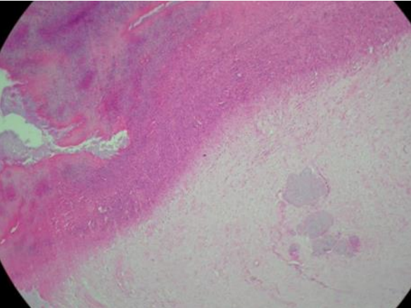 Coxim plantar direito de pinguim-de-Magalhães (Spheniscus magellanicus) com pododermatite grau III